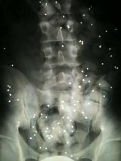 spezifische Ursache für Rückenschmerzen