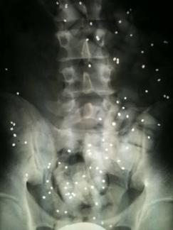 spezifische Ursache für Rückenschmerzen